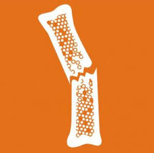 درمان ضعف استخوان