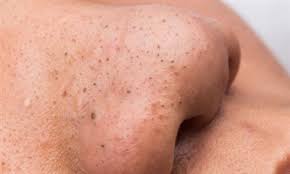 جوش های سر سیاه